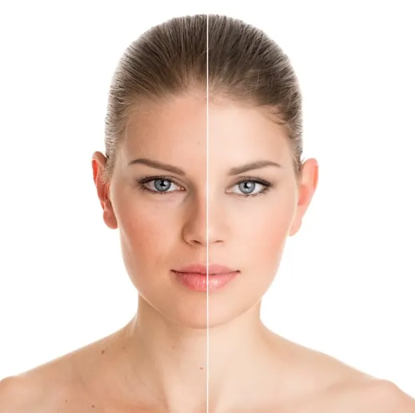 Photo rejuvenation light therapy on facial skin